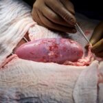 pig kidney in transplant