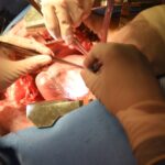 maryland pig heart transplant